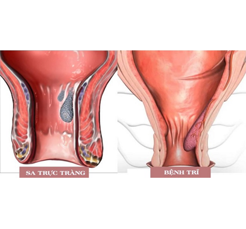 Bệnh trĩ, sa trực tràng